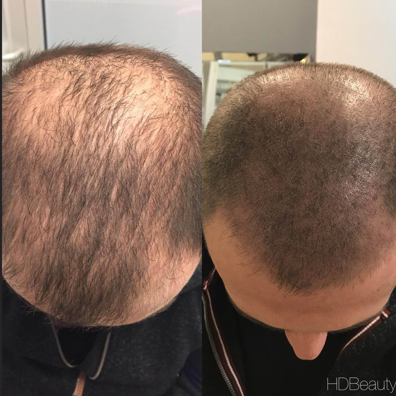 Before after bald head